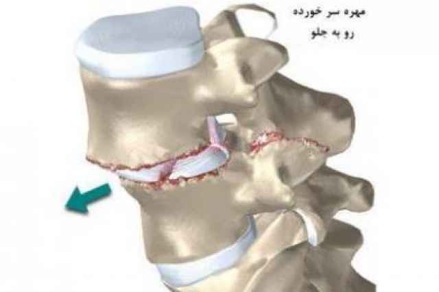 درمان سلولي ديسك كمر و گردن با ليزر سلولي در غرب تهران